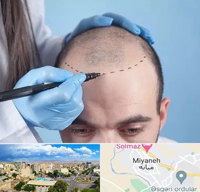 کاشت مو اقساطی در میانه