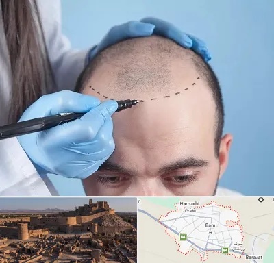 کاشت مو اقساطی در بم