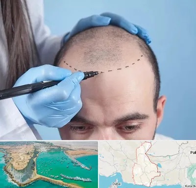 کاشت مو اقساطی در سیستان و بلوچستان