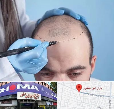 کاشت مو اقساطی در امین حضور