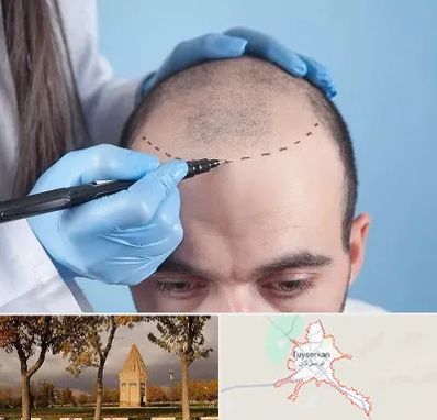 کاشت مو اقساطی در تویسرکان