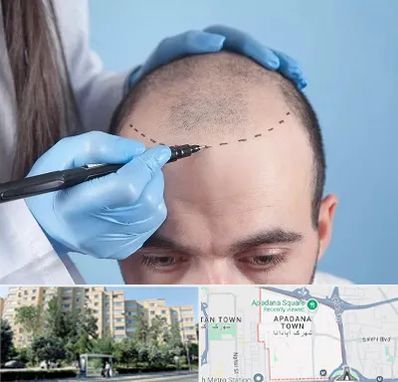 کاشت مو اقساطی در آپادانا