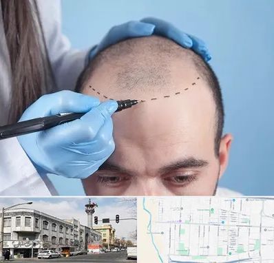 کاشت مو اقساطی در 17شهریور