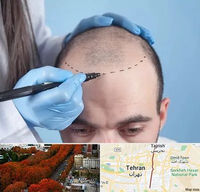 کاشت مو اقساطی در ولیعصر 