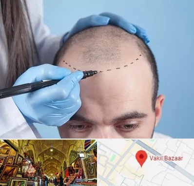 کاشت مو اقساطی در بازار وکیل شیراز