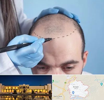 کاشت مو اقساطی در برازجان