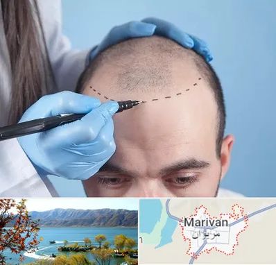 کاشت مو اقساطی در مریوان