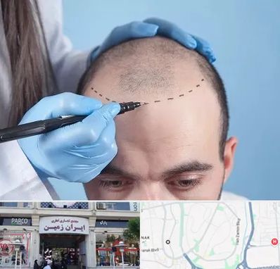 کاشت مو اقساطی در ایران زمین