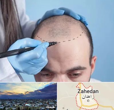 کاشت مو اقساطی در زاهدان