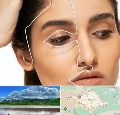 عمل بینی اقساطی در مرند