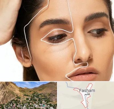 عمل بینی اقساطی در فشم