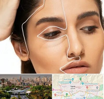 عمل بینی اقساطی در منطقه 1 تهران 