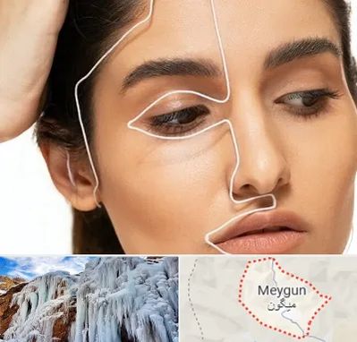 عمل بینی اقساطی در میگون