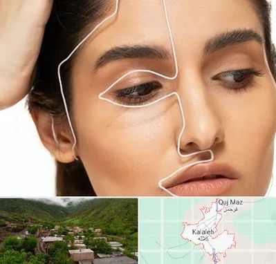 عمل بینی اقساطی در کلاله