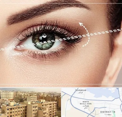 جراحی چشم گربه ای در جنوب غرب تهران