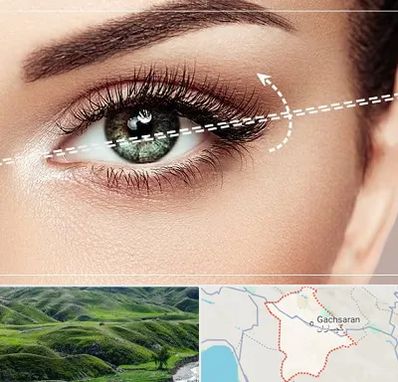 جراحی چشم گربه ای در گچساران