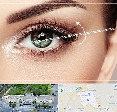 جراحی چشم گربه ای در نسیم شهر