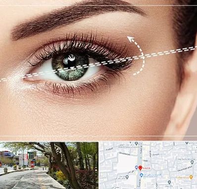 جراحی چشم گربه ای در خیابان توحید اصفهان