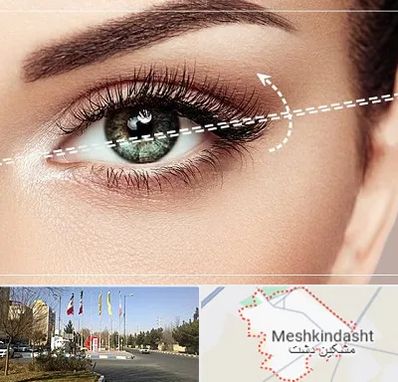 جراحی چشم گربه ای در مشکین دشت