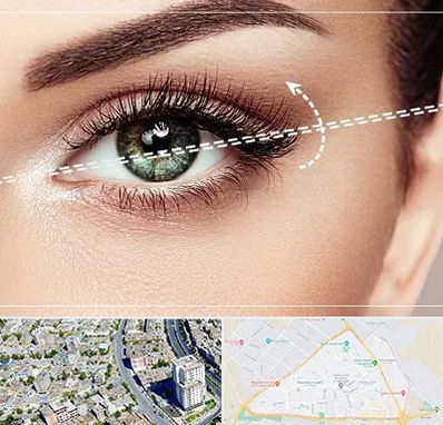 جراحی چشم گربه ای در قاسم آباد مشهد 