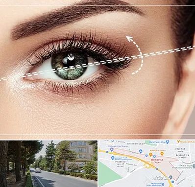 جراحی چشم گربه ای در مهرویلا کرج