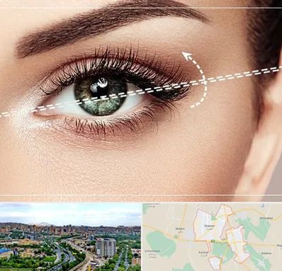 جراحی چشم گربه ای در شهریار