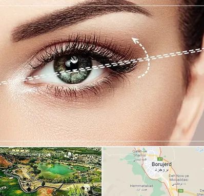 جراحی چشم گربه ای در بروجرد