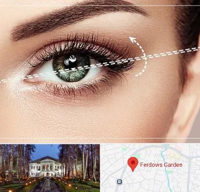 جراحی چشم گربه ای در باغ فردوس