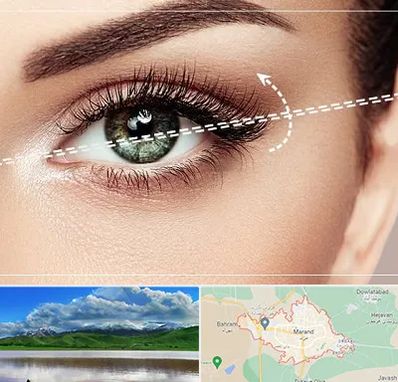 جراحی چشم گربه ای در مرند