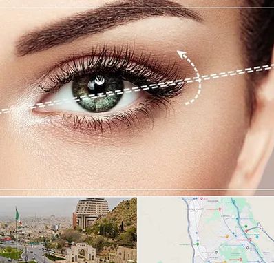 جراحی چشم گربه ای در فرهنگ شهر شیراز