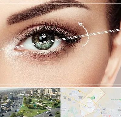 جراحی چشم گربه ای در کمال شهر کرج 