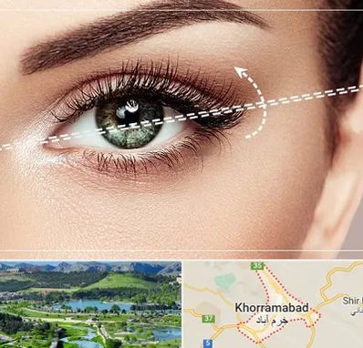 جراحی چشم گربه ای در خرم آباد