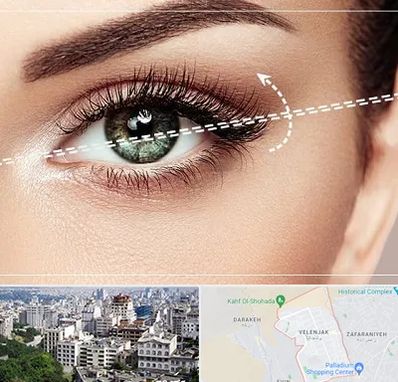 جراحی چشم گربه ای در ولنجک 