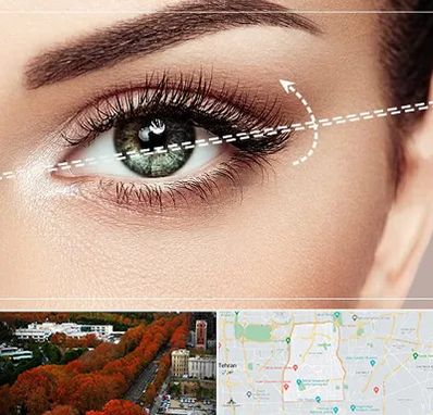 جراحی چشم گربه ای در منطقه 6 تهران 