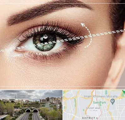 جراحی چشم گربه ای در یوسف آباد 