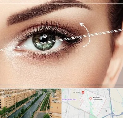 جراحی چشم گربه ای در فاز سه اندیشه