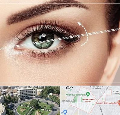 جراحی چشم گربه ای در جهانشهر کرج 