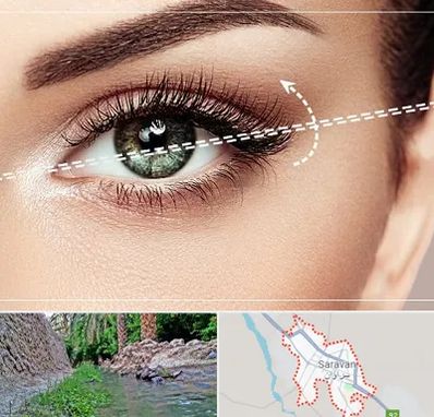 جراحی چشم گربه ای در سراوان