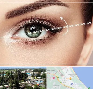 جراحی چشم گربه ای در رودسر