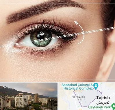 جراحی چشم گربه ای در زعفرانیه 