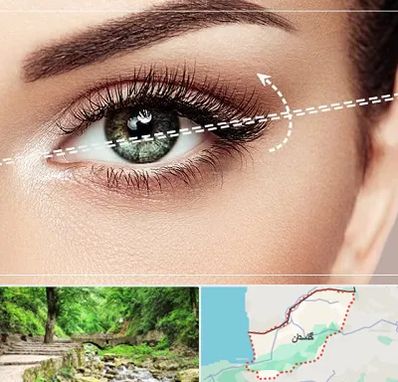 جراحی چشم گربه ای در گلستان
