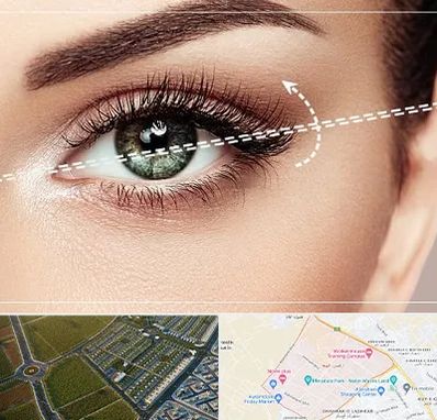 جراحی چشم گربه ای در الهیه مشهد