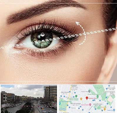 جراحی چشم گربه ای در بلوار فردوسی مشهد 