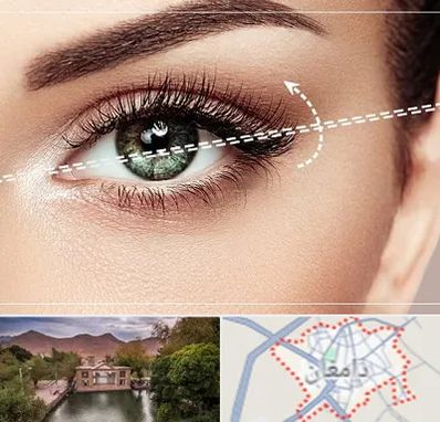 جراحی چشم گربه ای در دامغان
