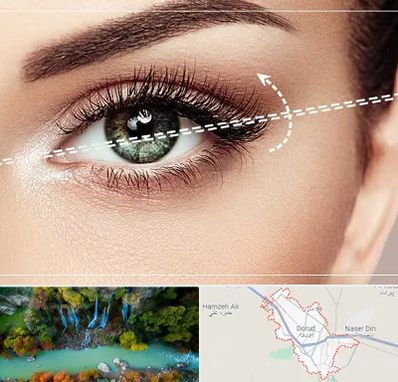 جراحی چشم گربه ای در دورود