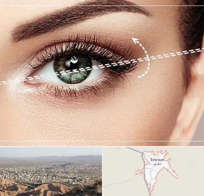 جراحی چشم گربه ای در اسفراین