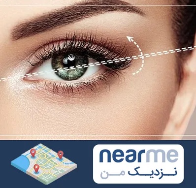 جراحی چشم گربه ای در نزدیک من