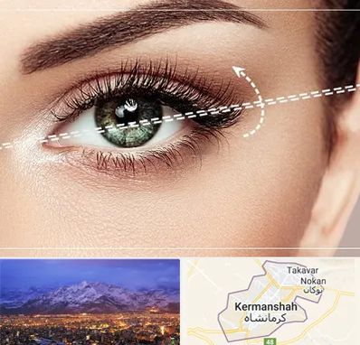 جراحی چشم گربه ای در کرمانشاه
