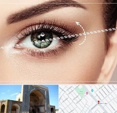 جراحی چشم گربه ای در مصلی مشهد