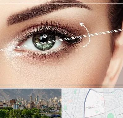 جراحی چشم گربه ای در جمشیدیه